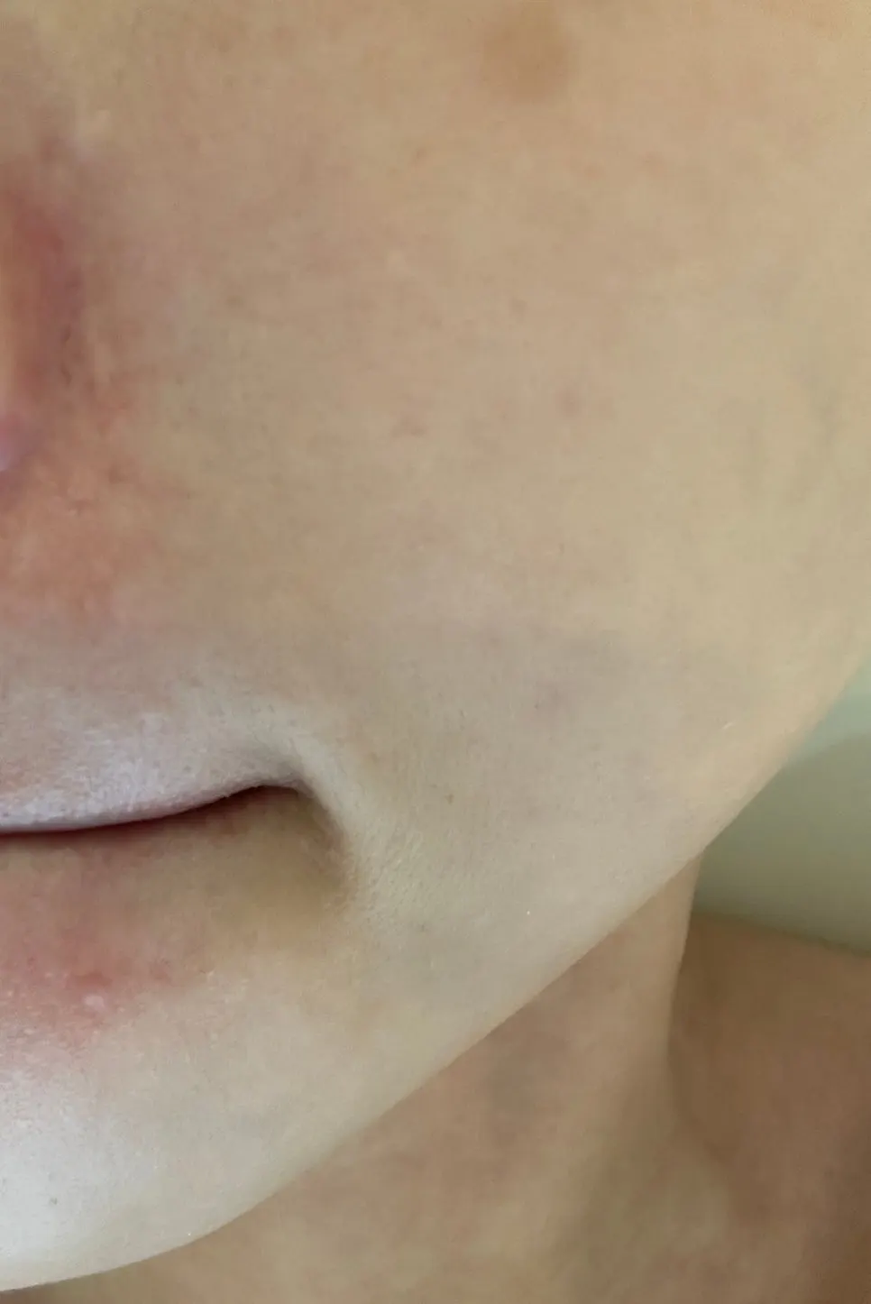 Rough skin condition before treatment