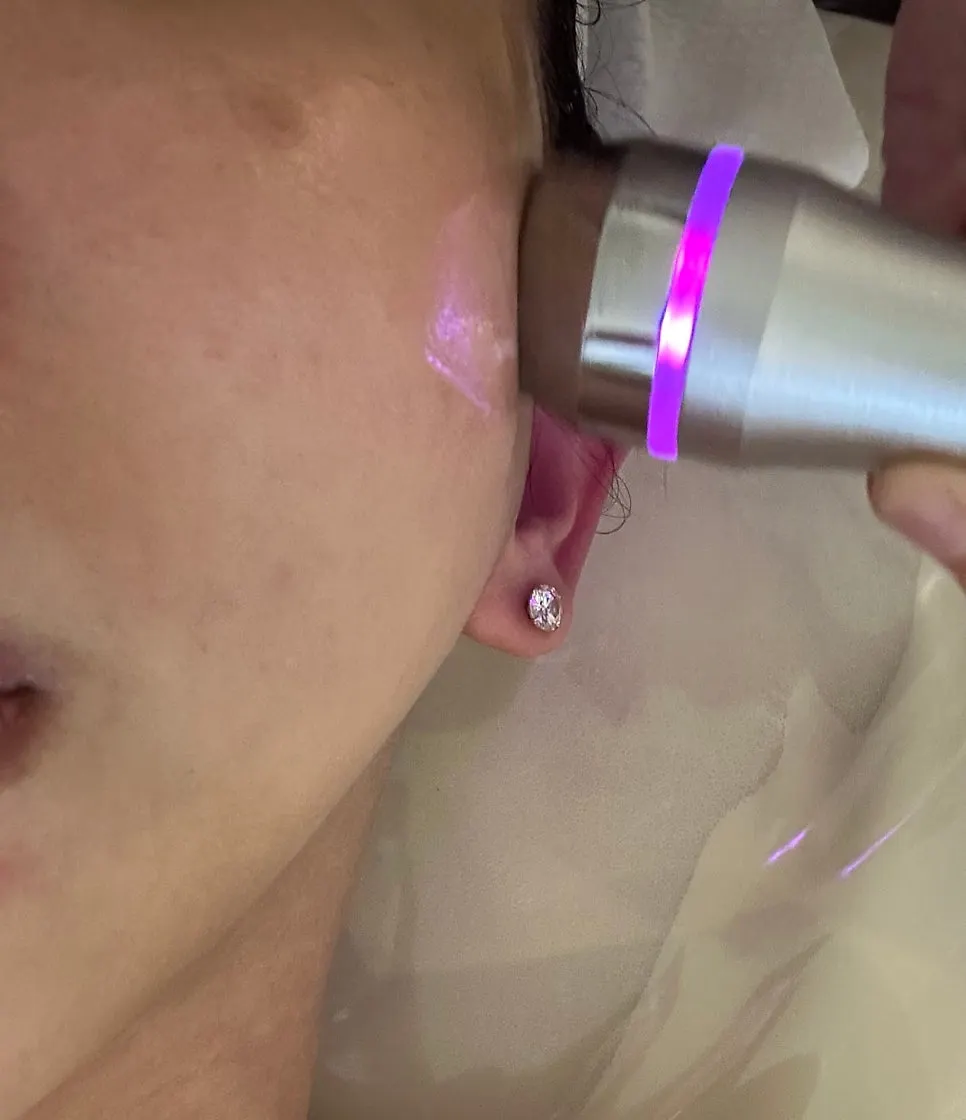Preparing to apply the PDRN ampoule