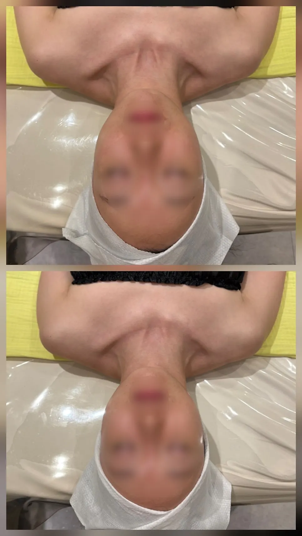 轮廓缩小管理结束后的脸部线条