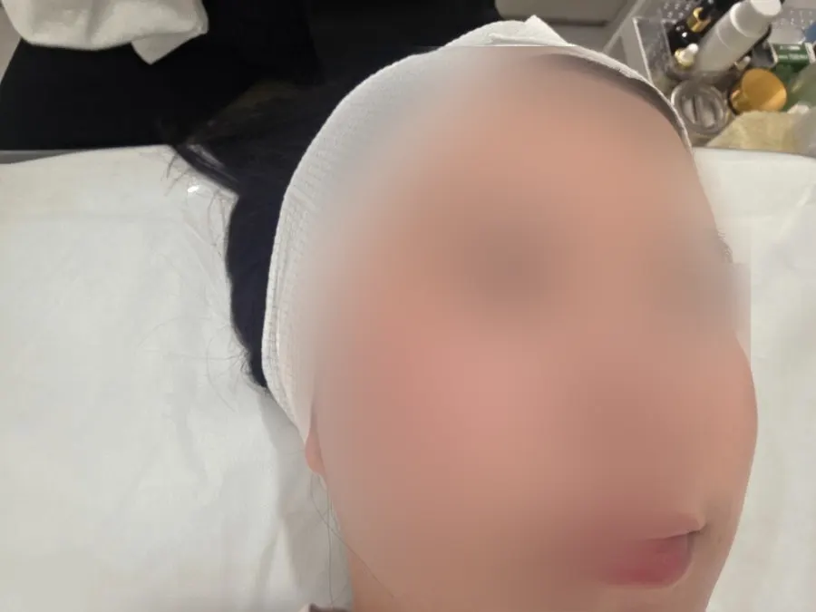 Redness and sunburned skin condition before cleansing
