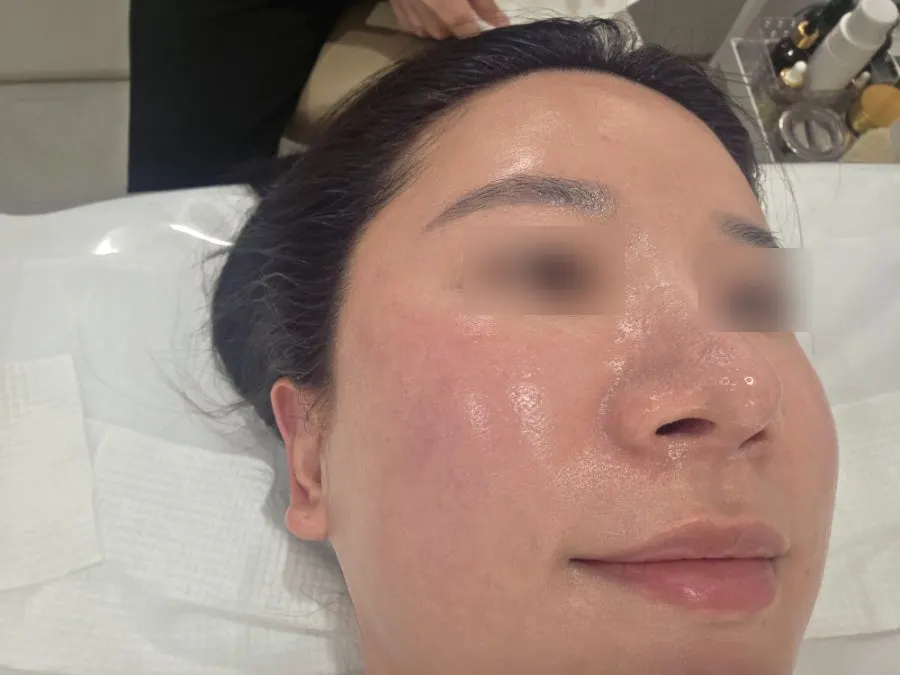 Skin right after treatment with only the mask pack removed