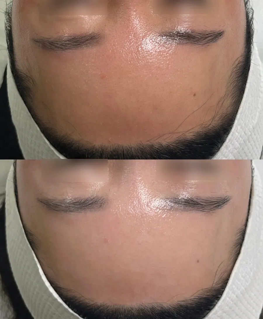 Comparison of skin tone before and after Rebe Look treatment