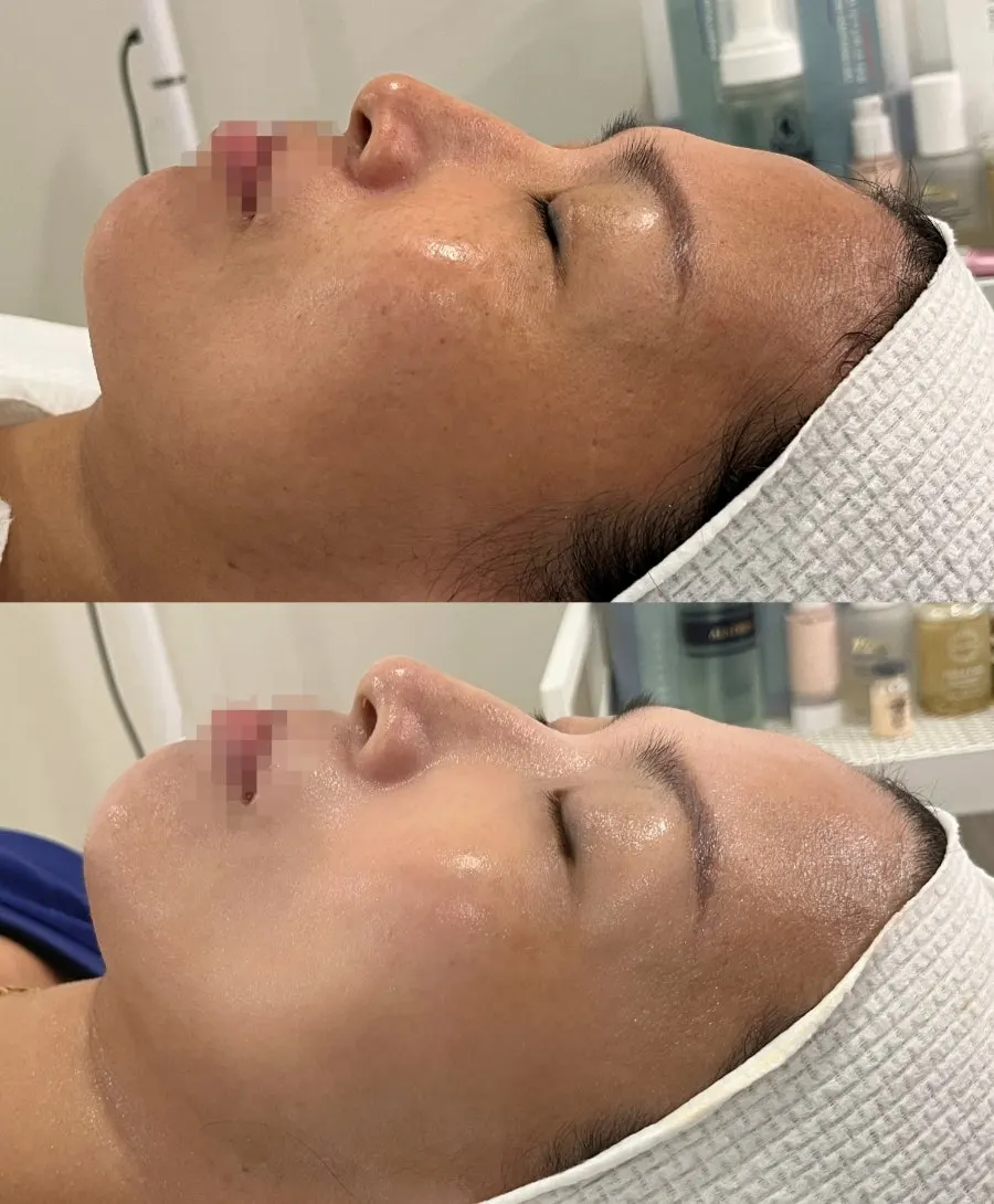 관리 전후 비교를 위한 피부 촬영 화면