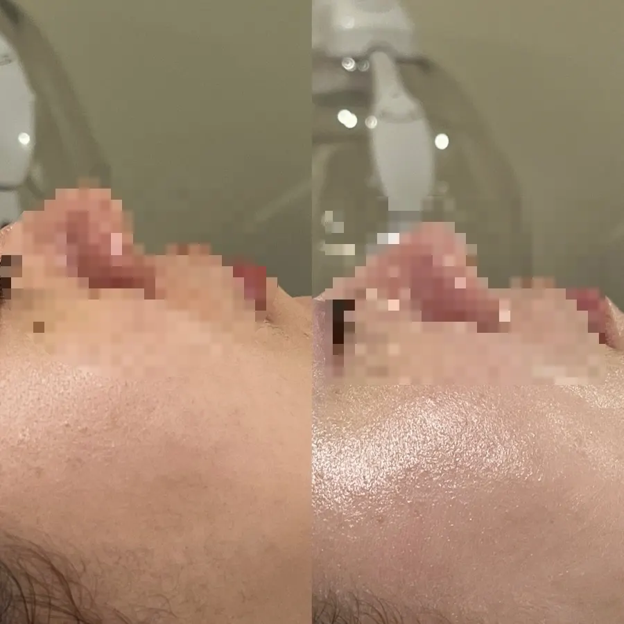 리베룩 케어 전후 비교 사진