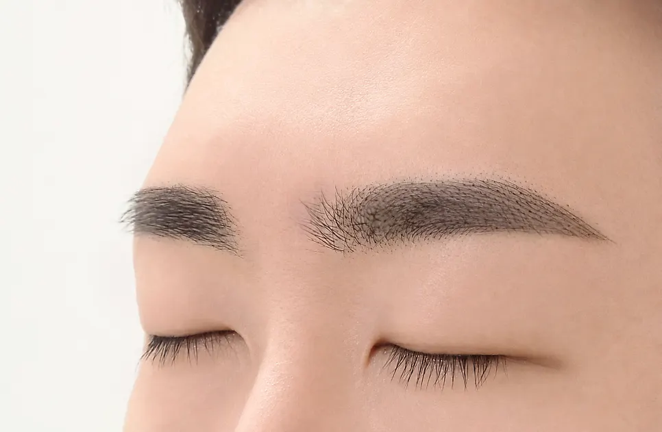 Combo eyebrow procedure with corrections and refinements
