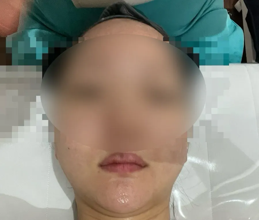 Lower face before lifting and double chin improvement treatment