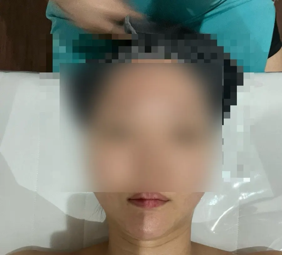 Checking the lower face line after the treatment