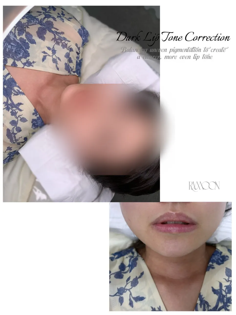 Lip progress while peeling after semi-permanent makeup