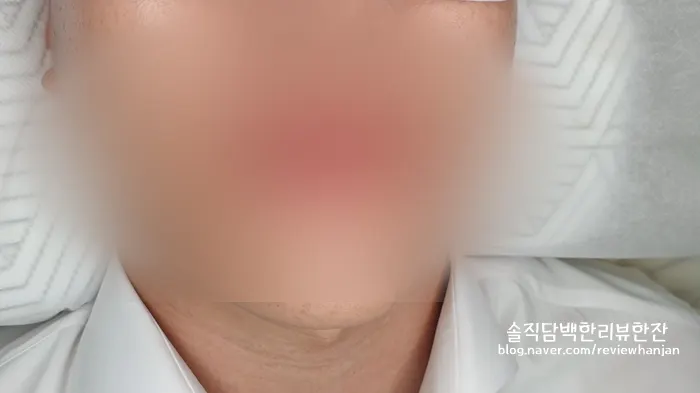 Lip color after the lip tattooing procedure