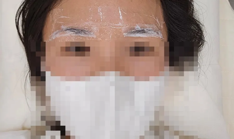 마취크림을 바른 시술 전 준비 모습