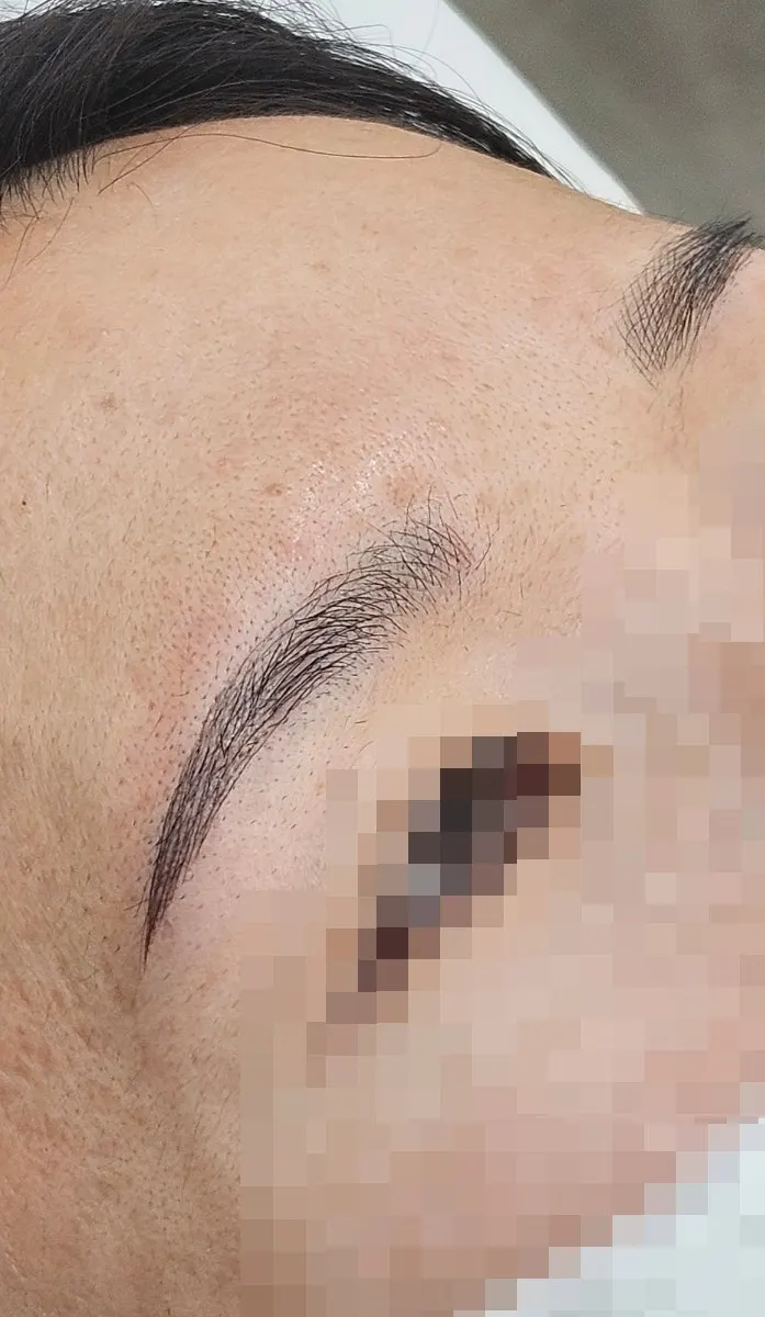 시술 후 정면에서 본 눈썹