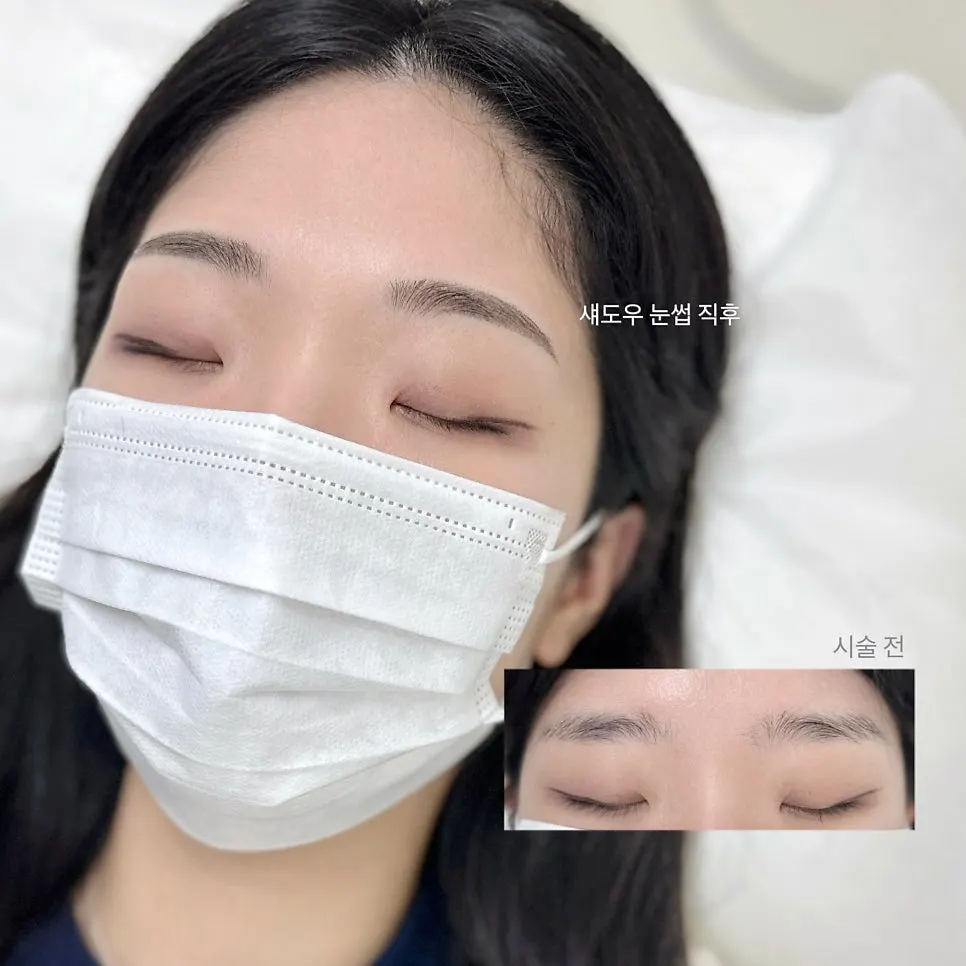Front view of filled-in eyebrows after the procedure