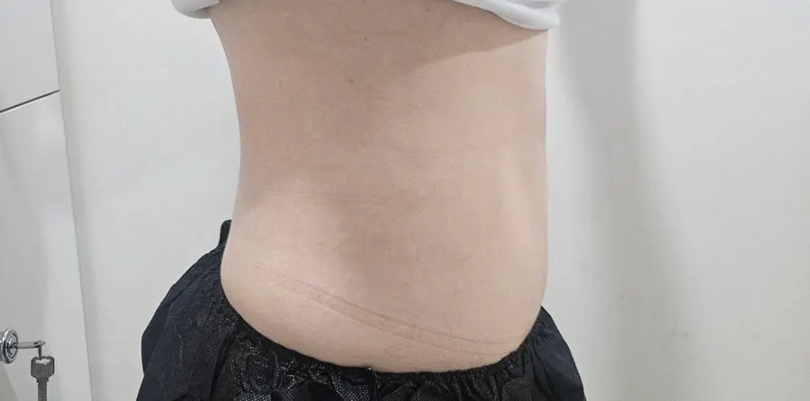 TNT 복부관리 1회 후 애프터 복부 라인