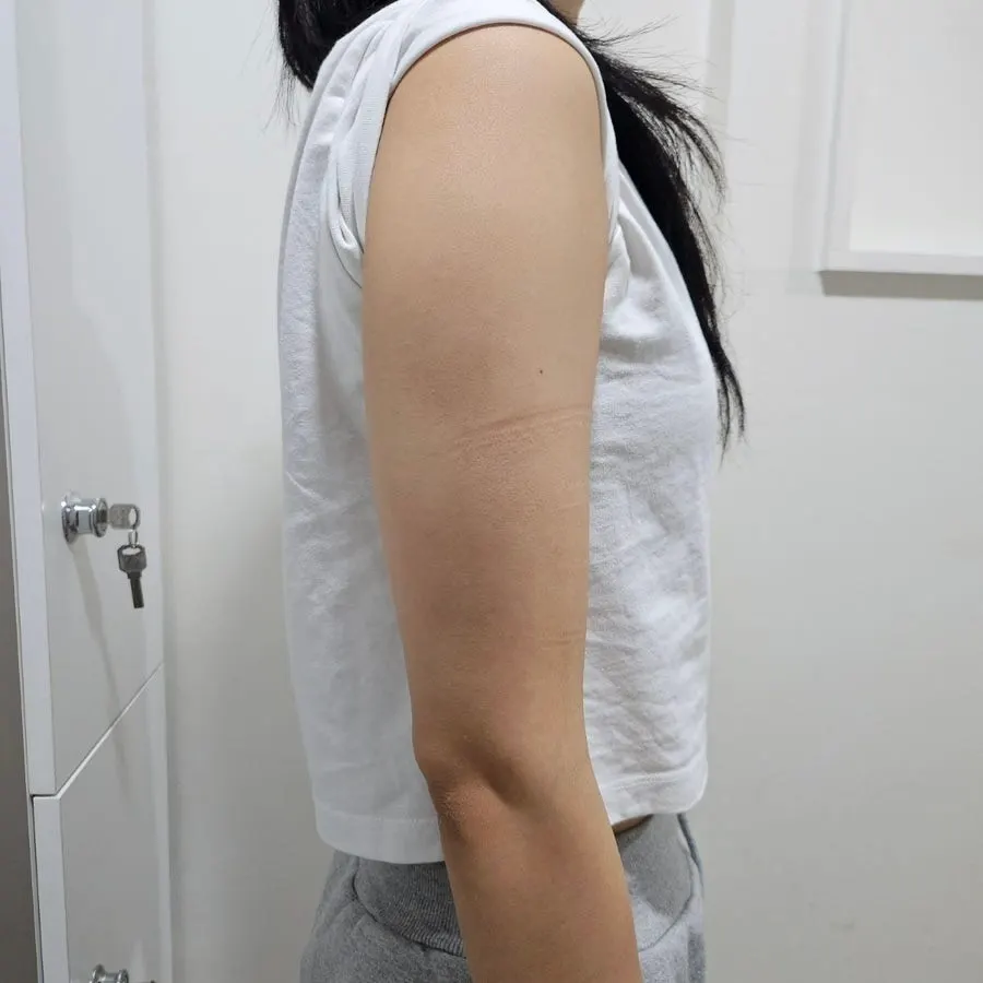 Information image on the Seomyeon arm treatment