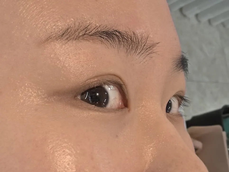Consultation about concerns with the right eyelashes