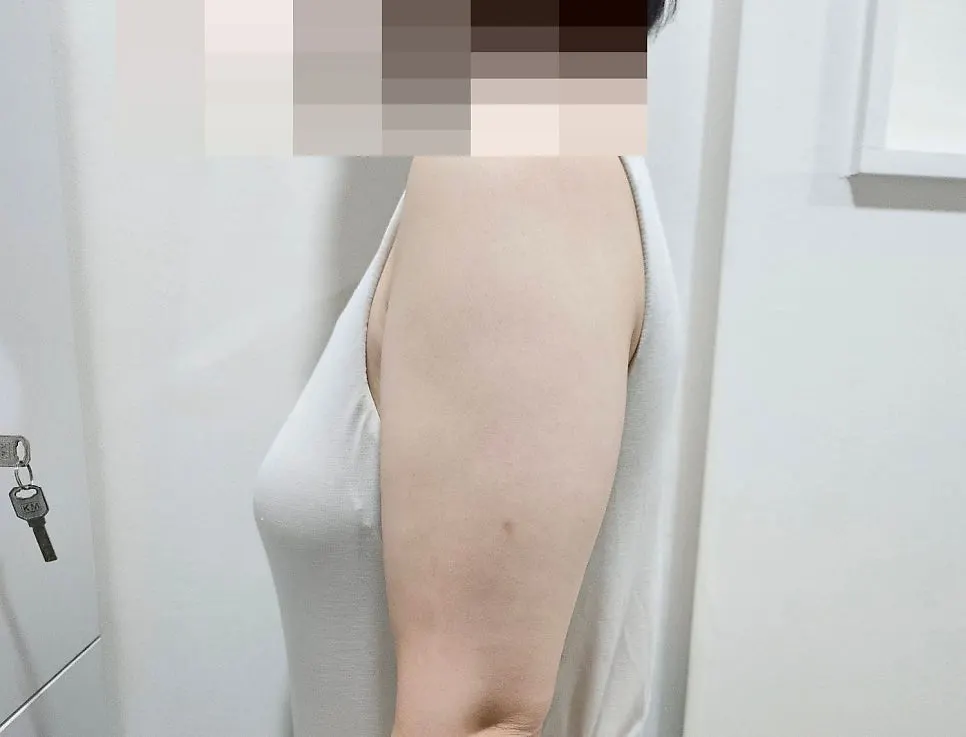 Arm before the TNT arm care treatment
