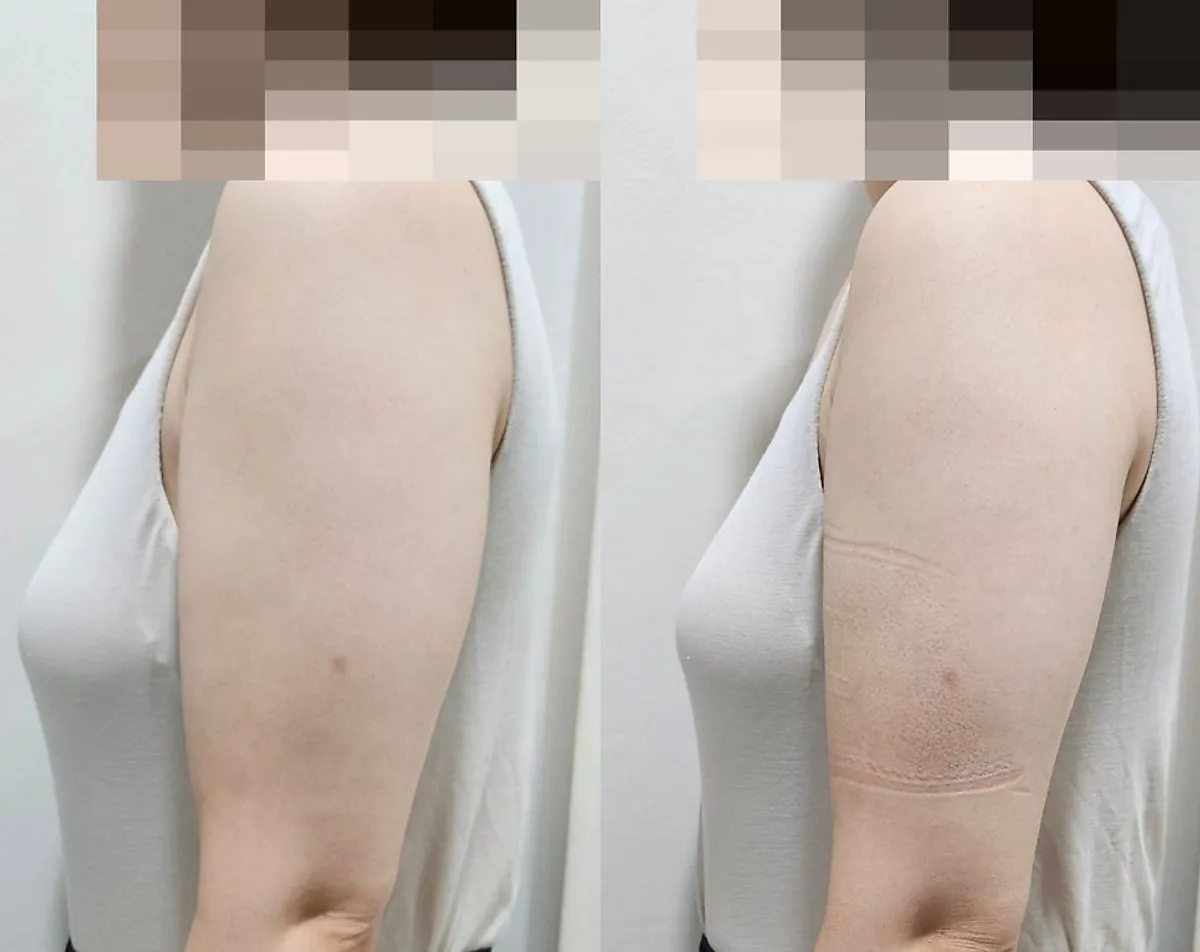 Before-and-after comparison of the TNT arm care