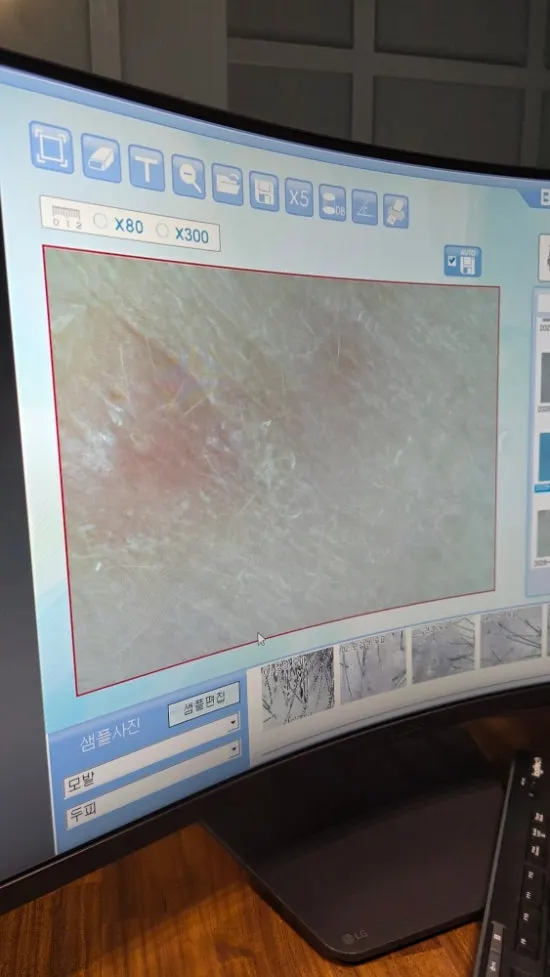 Zoomed-in scan image showing lifted dead skin