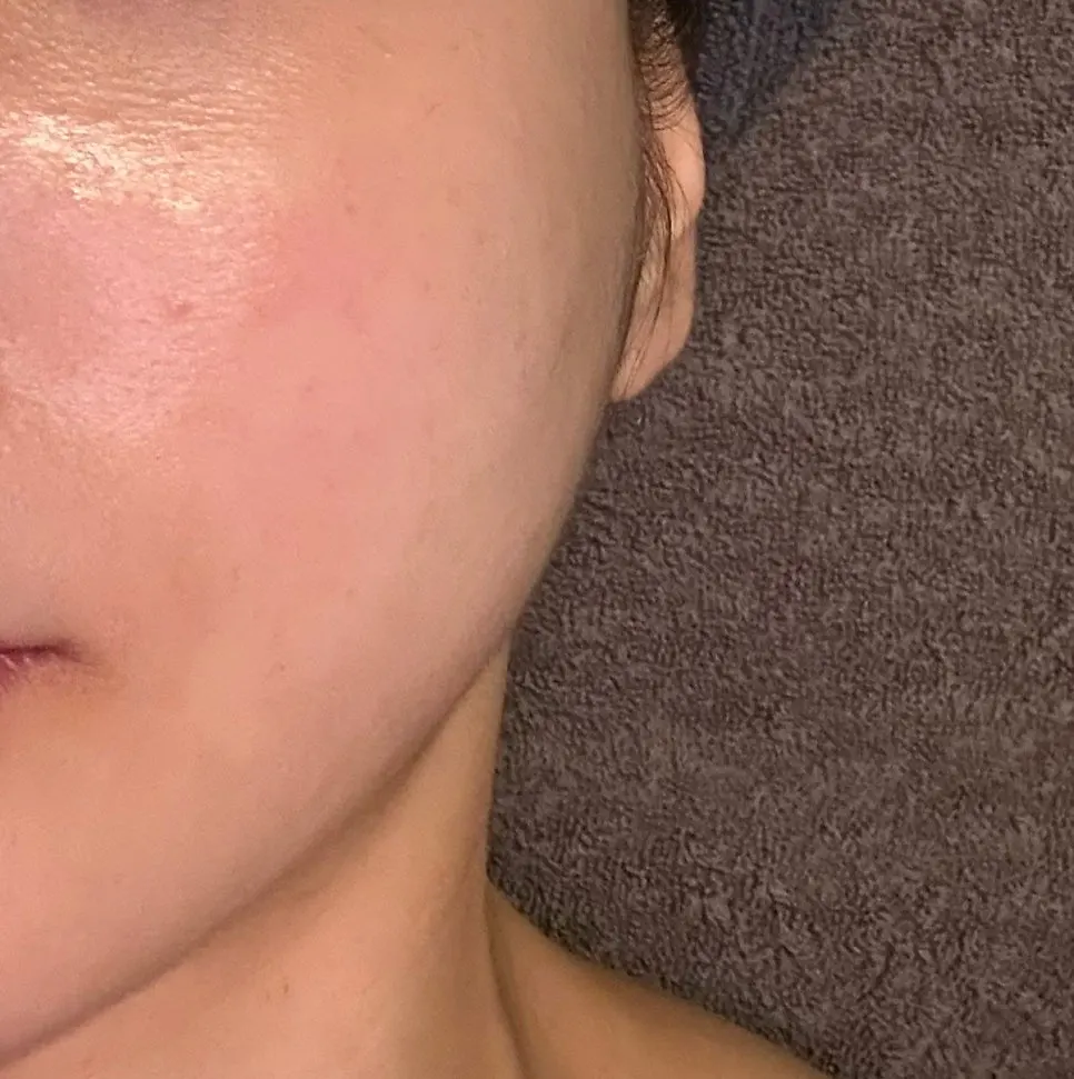 안면홍조 관리 전후 비포애프터 비교
