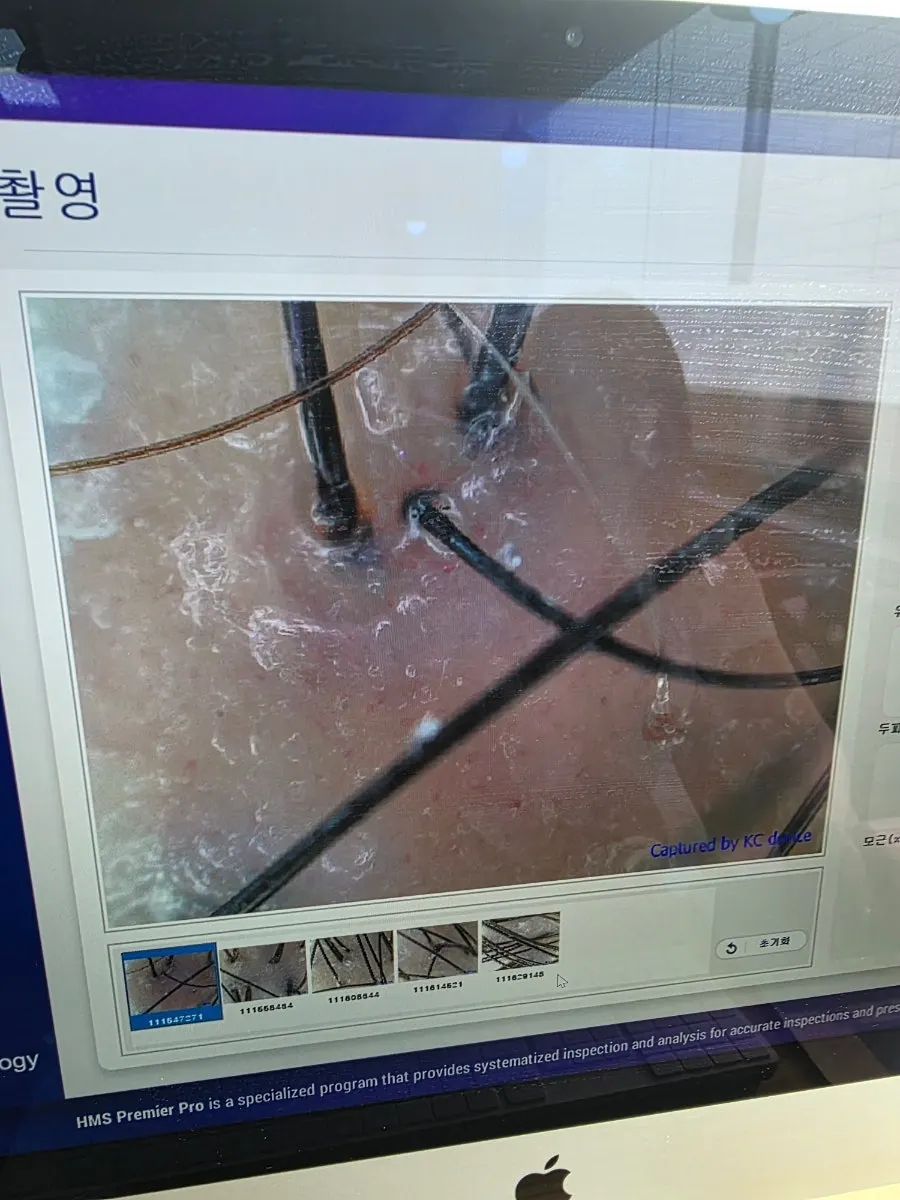 딥 스케일링 시술 준비 모습