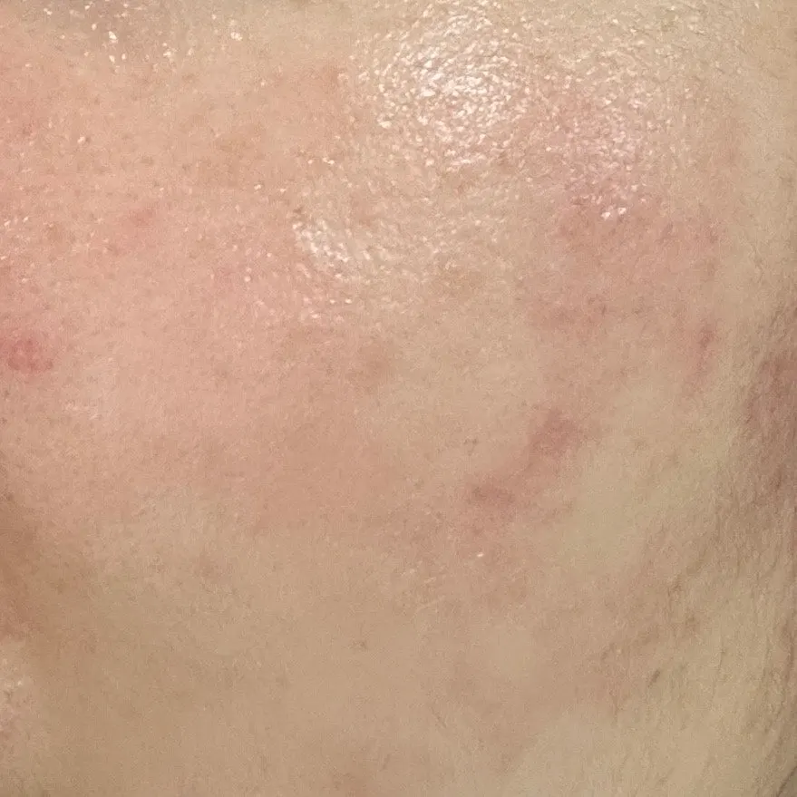 관리 일주일 뒤 가라앉은 볼 앞쪽 피부