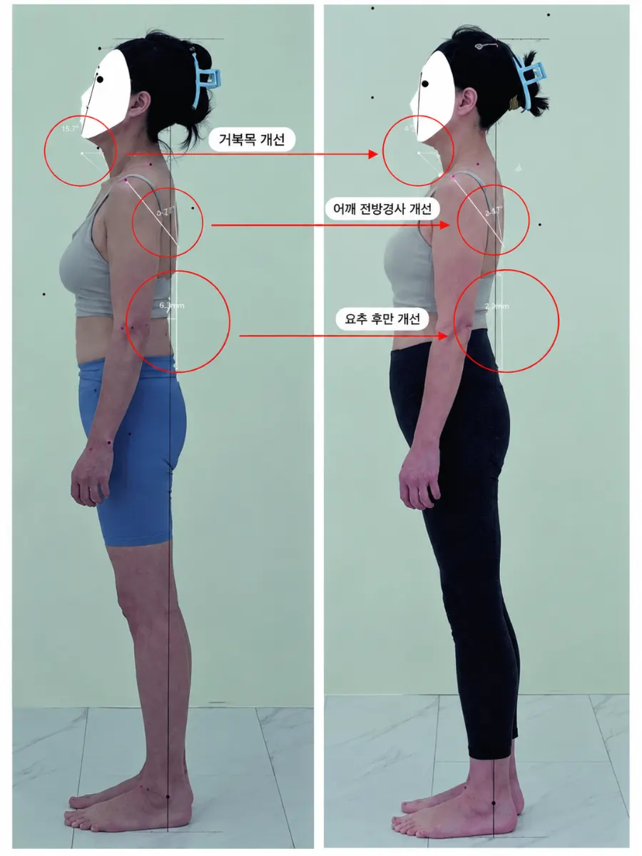 Before-and-after comparison of back-of-neck line and shoulder height