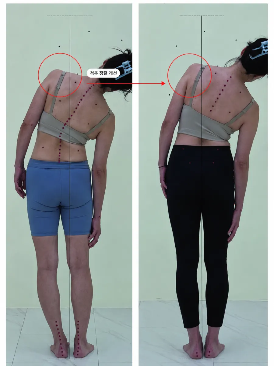 Side-view before-and-after comparison of forward head posture and lower back line
