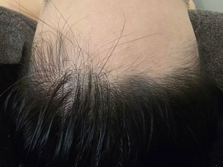 M자 진행 중인 헤어라인 확인 모습