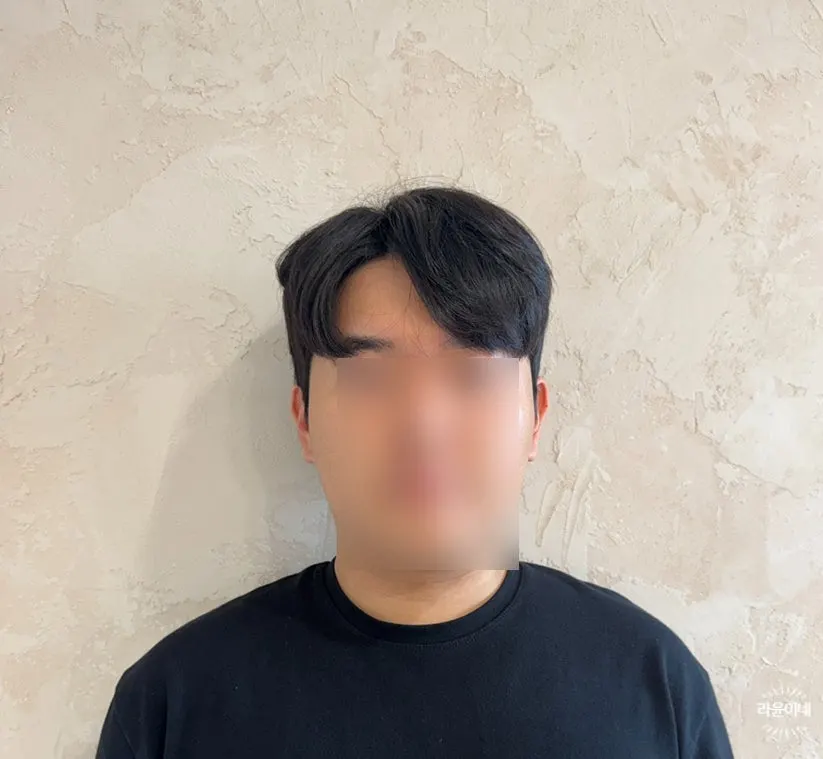 간격이 넉넉한 시술석