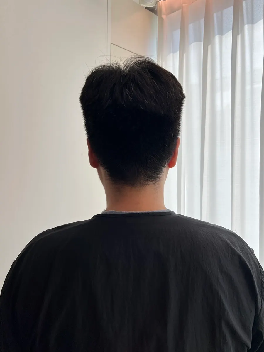 시술 전 직모 상태의 옆모습