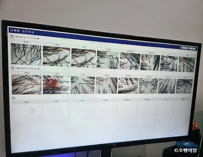 Perbandingan close-up kulit kepala sebelum dan sesudah perawatan kombinasi