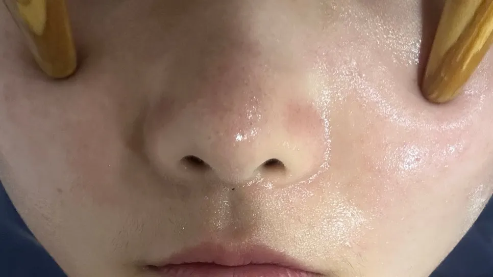 Facial treatment after cleansing