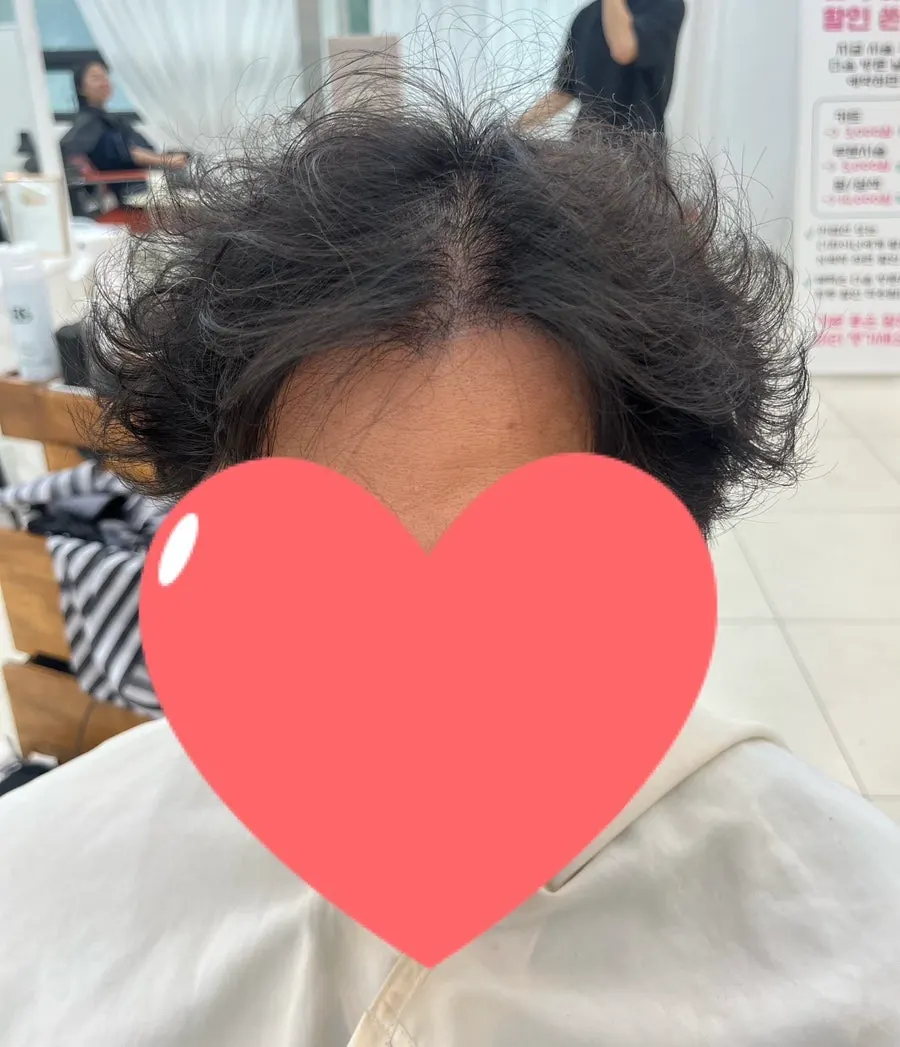 시술 전 볼륨 없는 남자 모발 상태